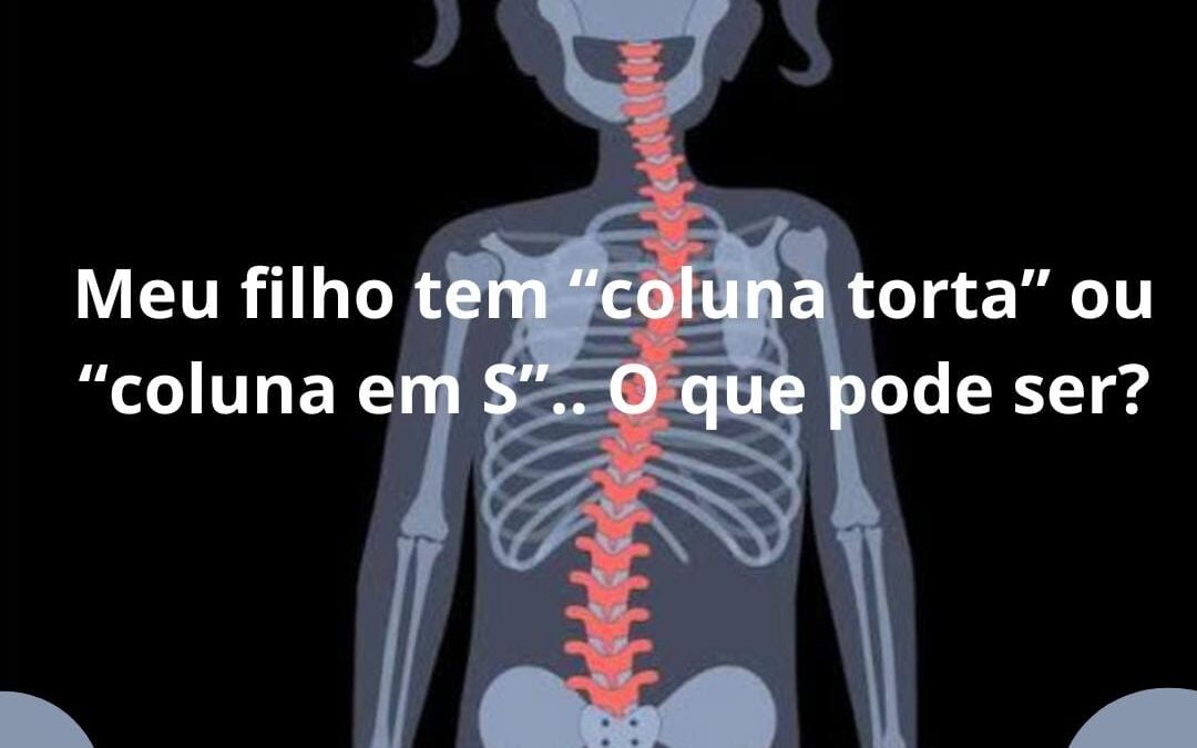 Meu filho tem “coluna torta” ou “coluna em S”.. O que pode ser?